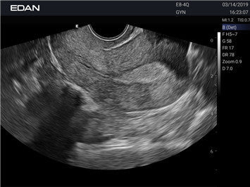 Edan Acclarix AX2 Compact Color Doppler Ultrasound System - Ultrasound System | CincyMed