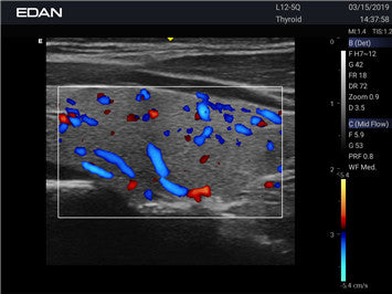 Edan Acclarix AX3 Compact Color Doppler Ultrasound System - Ultrasound System | CincyMed