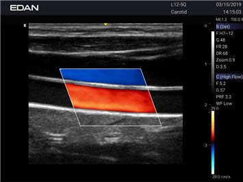 Edan Acclarix AX2 Compact Color Doppler Ultrasound System - Ultrasound System | CincyMed