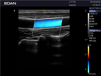 Edan Acclarix AX3 Compact Color Doppler Ultrasound System - Ultrasound System | CincyMed