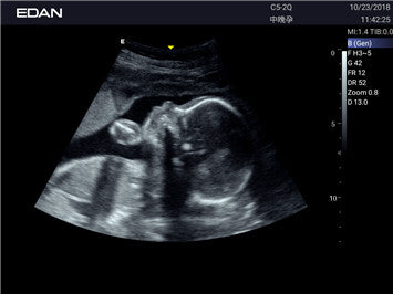 Edan Acclarix AX2 Compact Color Doppler Ultrasound System - Ultrasound System | CincyMed