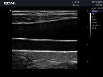 Edan Acclarix AX3 Compact Color Doppler Ultrasound System - Ultrasound System | CincyMed