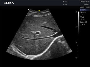 Edan Acclarix AX2 Compact Color Doppler Ultrasound System - Ultrasound System | CincyMed