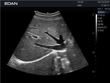 Edan Acclarix AX2 Compact Color Doppler Ultrasound System - Ultrasound System | CincyMed