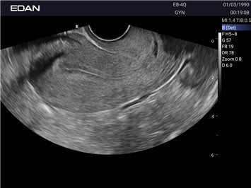 Edan Acclarix AX2 Compact Color Doppler Ultrasound System - Ultrasound System | CincyMed