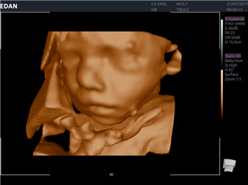 Edan Acclarix AX8 Ultrasound Machine - Ultrasound System | CincyMed