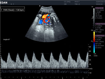 Edan Acclarix AX8 Ultrasound Machine - Ultrasound System | CincyMed