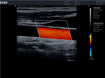 Edan Acclarix AX8 Ultrasound Machine - Ultrasound System | CincyMed