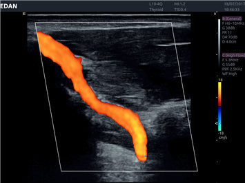 Edan Acclarix AX8 Ultrasound Machine - Ultrasound System | CincyMed