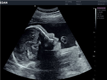 Edan Acclarix AX8 Ultrasound Machine - Ultrasound System | CincyMed
