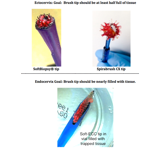 Soft ECC Endocervical Curette - Colposcopy | CincyMed